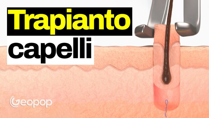 Trapianto di capelli