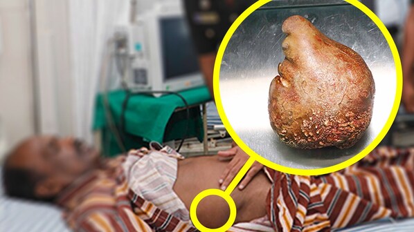 Calcoli Renali il più grande del mondo