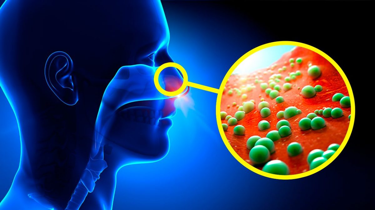 cosa sono le caccole del naso