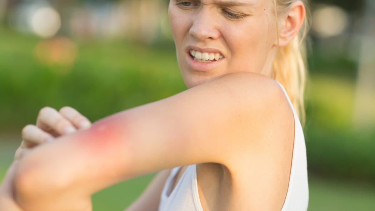 ridurre prurito punture di zanzara