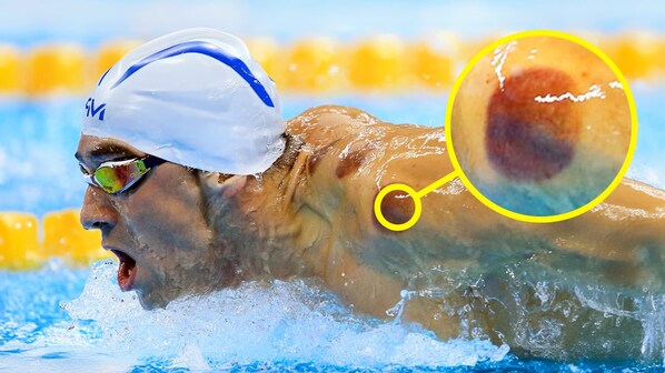 coppettazione nuotatori olimpiadi