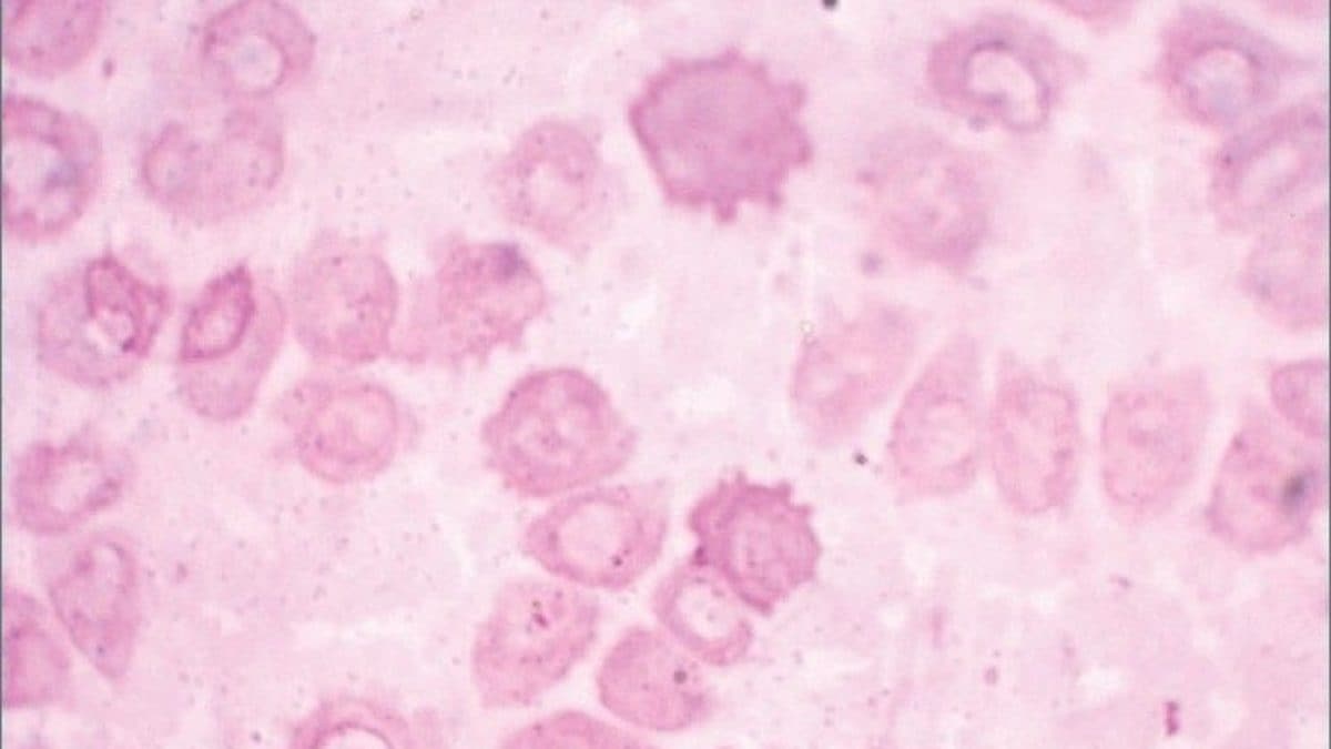 Porfiria