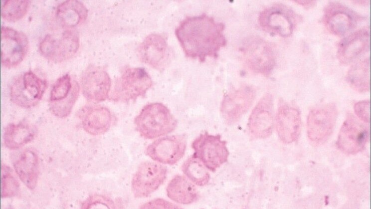 Porfiria
