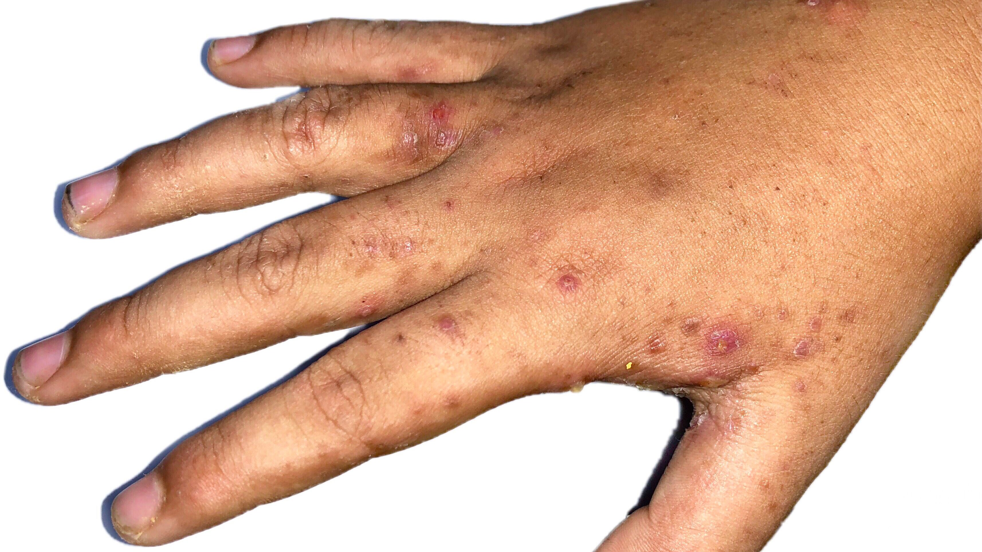 mano ferite da scabbia