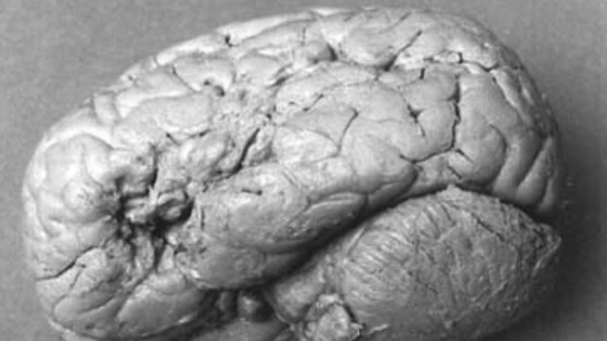 cervello paziente tan tan