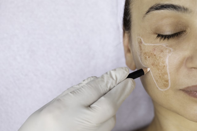 iperpigmentazione laser