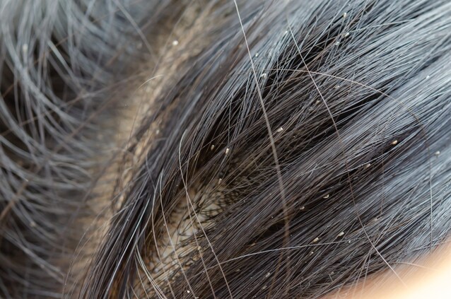 uova pidocchi capelli