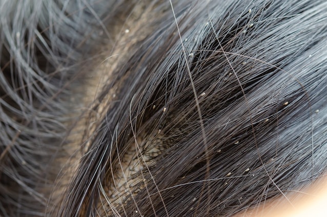 uova pidocchi capelli