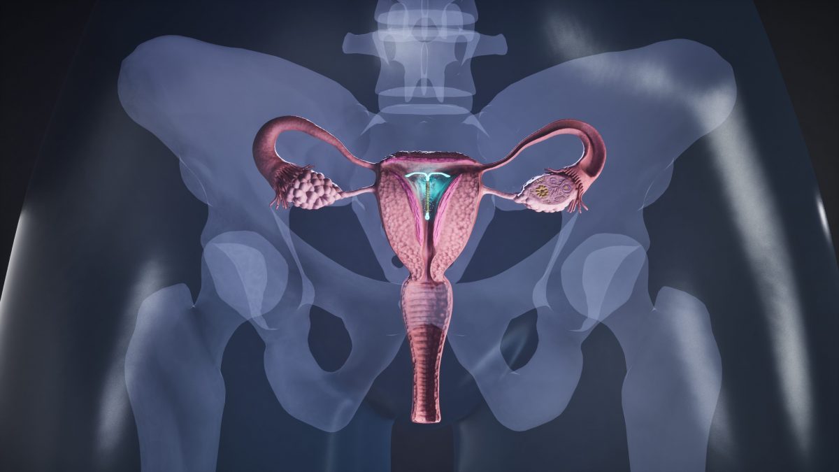 spirale metodi contraccettivi pillola minipillola coppetta cappuccio cervicale
