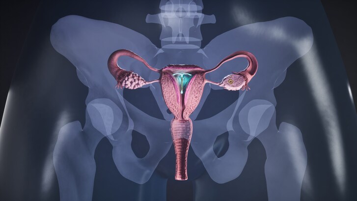 spirale metodi contraccettivi pillola minipillola coppetta cappuccio cervicale