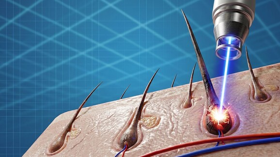 epilazione laser geopop