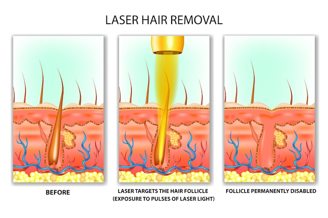 epilazione laser